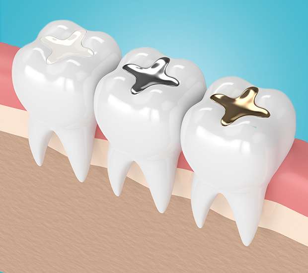 Hyattsville Composite Fillings