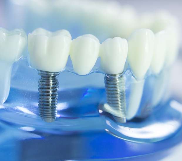 Hyattsville Dental Implants