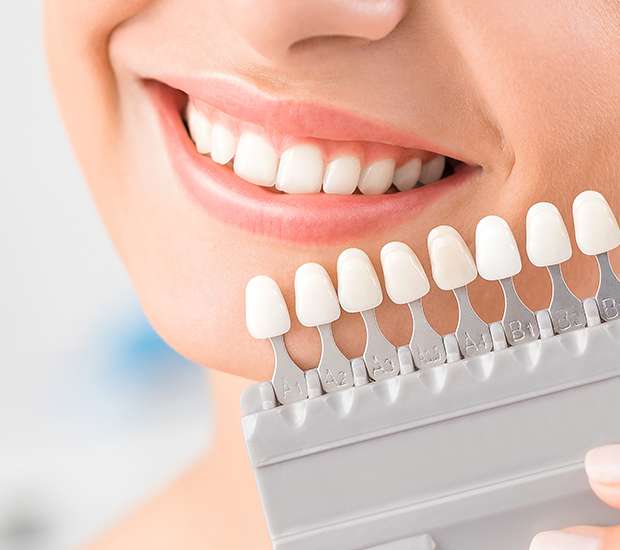 Hyattsville Dental Veneers and Dental Laminates