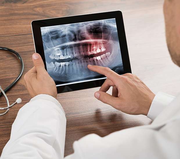 Hyattsville Types of Dental Root Fractures